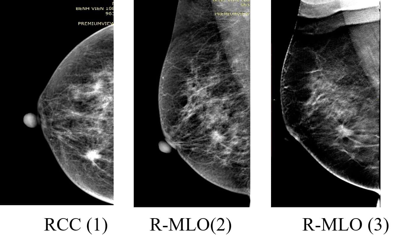 Chẩn đoán ung thư vú bằng Chụp nhũ ảnh (mammography)